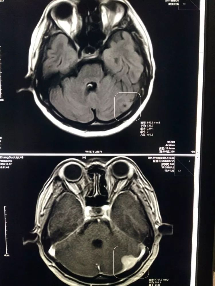 为了更好显示病变,磁共振室于2018年12月7日下午,为患者做了核磁增强