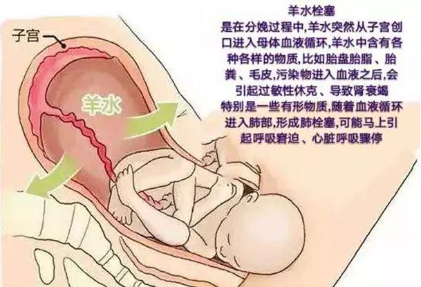 奪走劉強東妹妹生命的竟然是「產科死神」 健康 第2張