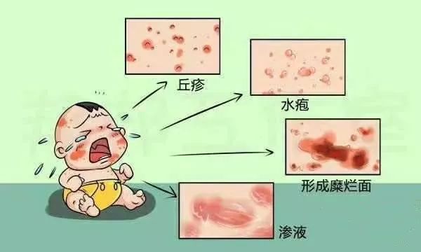 皮炎为特征,初发损害为红斑基础上出现密集粟粒大小丘疹,丘疱疹或水疱