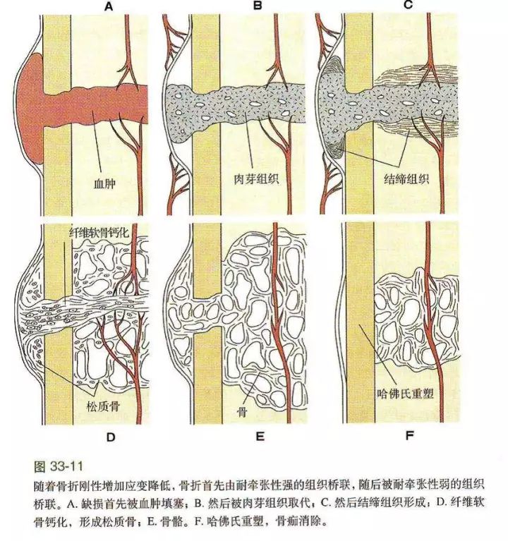 骨折胳膊伸不直怎么办