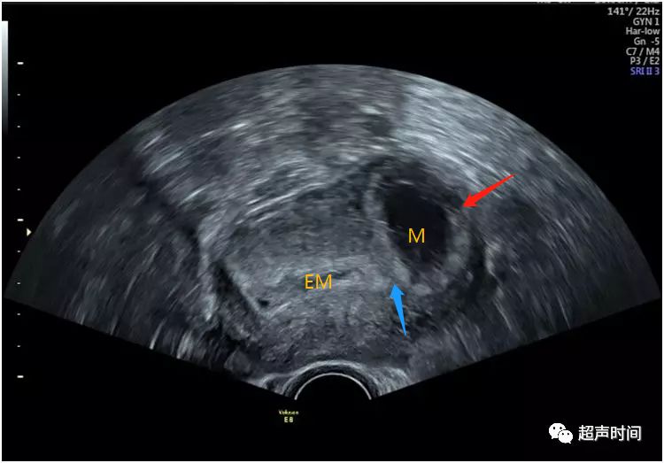 超声典型病例:间质部妊娠和宫角妊娠