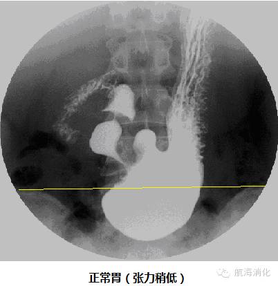 胃下垂,一个容易被忽视的餐后上腹胀痛的病因