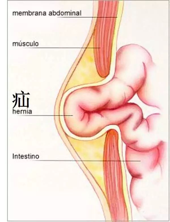 什么是疝气? 疝气俗称"小肠气".以轮胎比喻,腹壁如外胎,肠管如内胎.