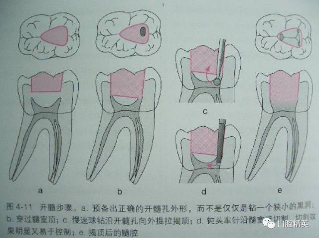 详解各牙位的开髓整理版