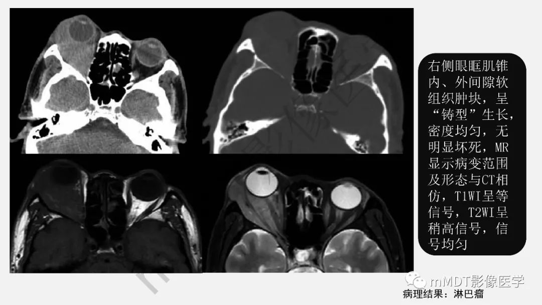 眼眶肌锥内常见肿块ct/mr诊断