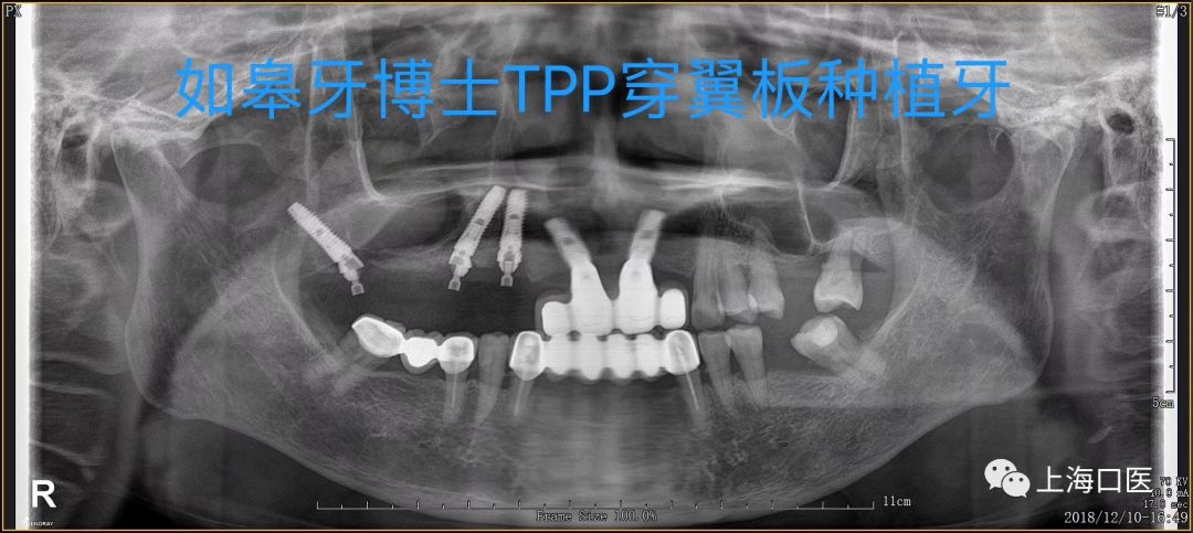 病例分享:tpp穿翼即刻负重种植牙