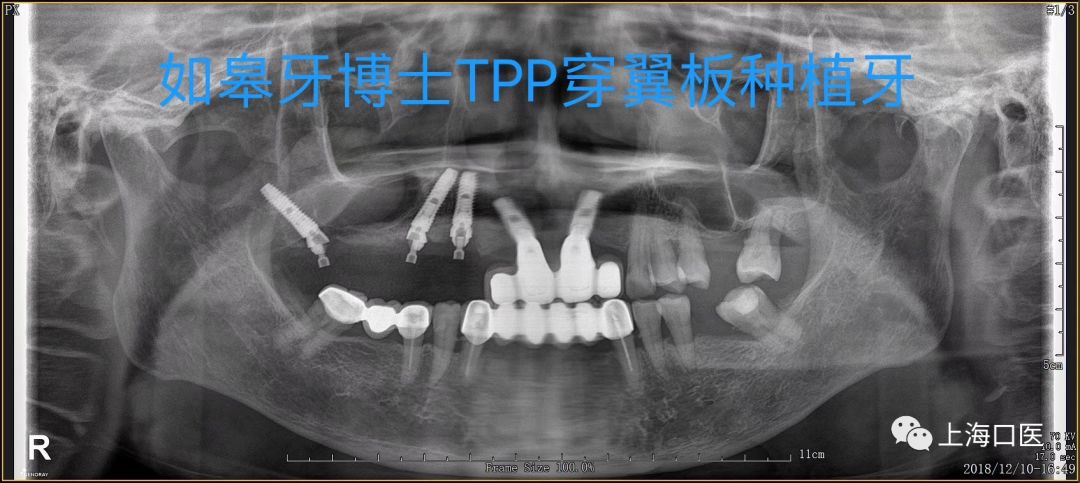 病例分享tpp穿翼即刻负重种植牙