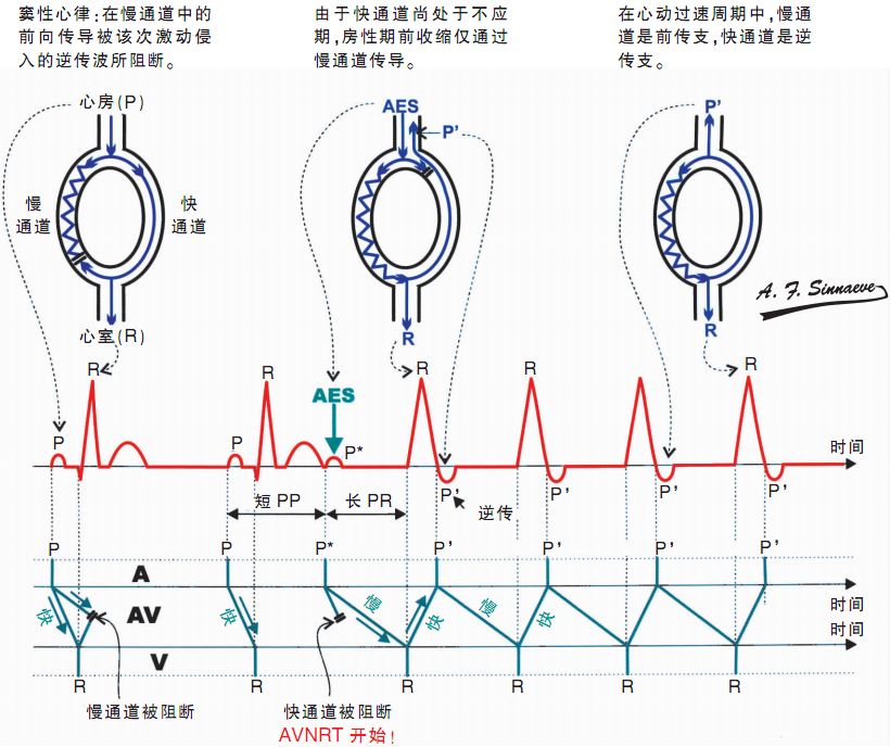 顺向房室折返性心动过速(ort) 一次ort的机制与avnrt极相似.