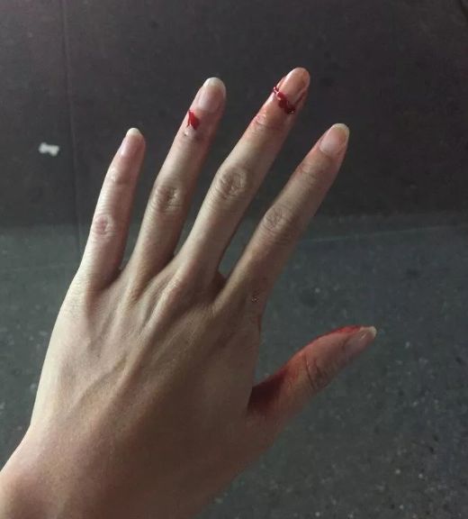 事后,女生发现她 左手两个手指被深深割破,鲜血淋淋,女生男友的下颌也