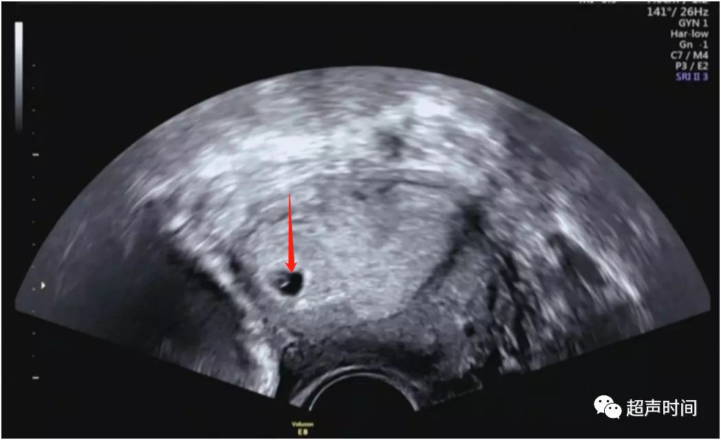超声典型病例:间质部妊娠和宫角妊娠