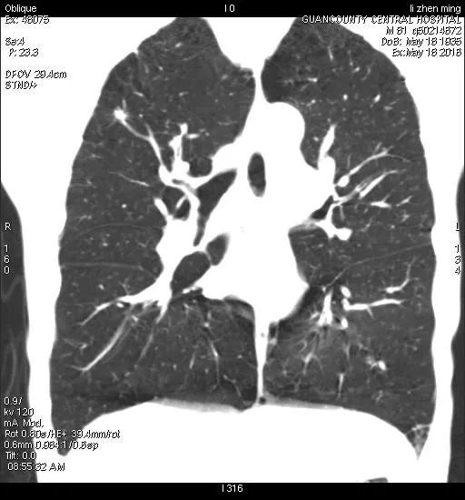 冠县中心医院早期肺癌筛查(胸部低剂量ct检查)持续进行中!