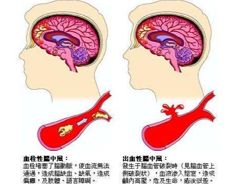 预防脑梗中风多喝三水降低脑血管垃圾三件事尽量少做