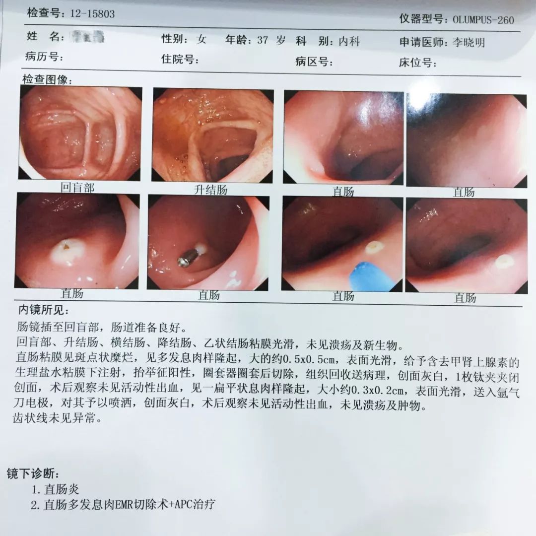 患者实录 | 反复腹痛腹胀,警惕直肠息肉