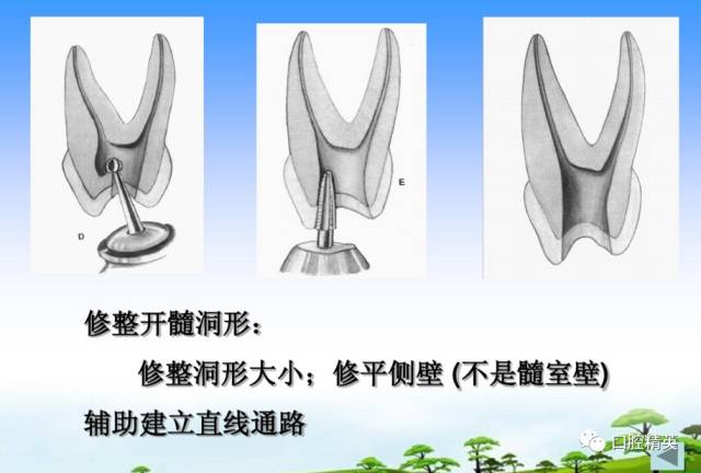 详解各牙位的开髓整理版