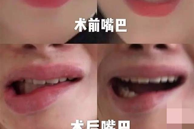 女子想变瓜子脸,手术后却变成歪嘴巴医生:提醒过你手术有风险