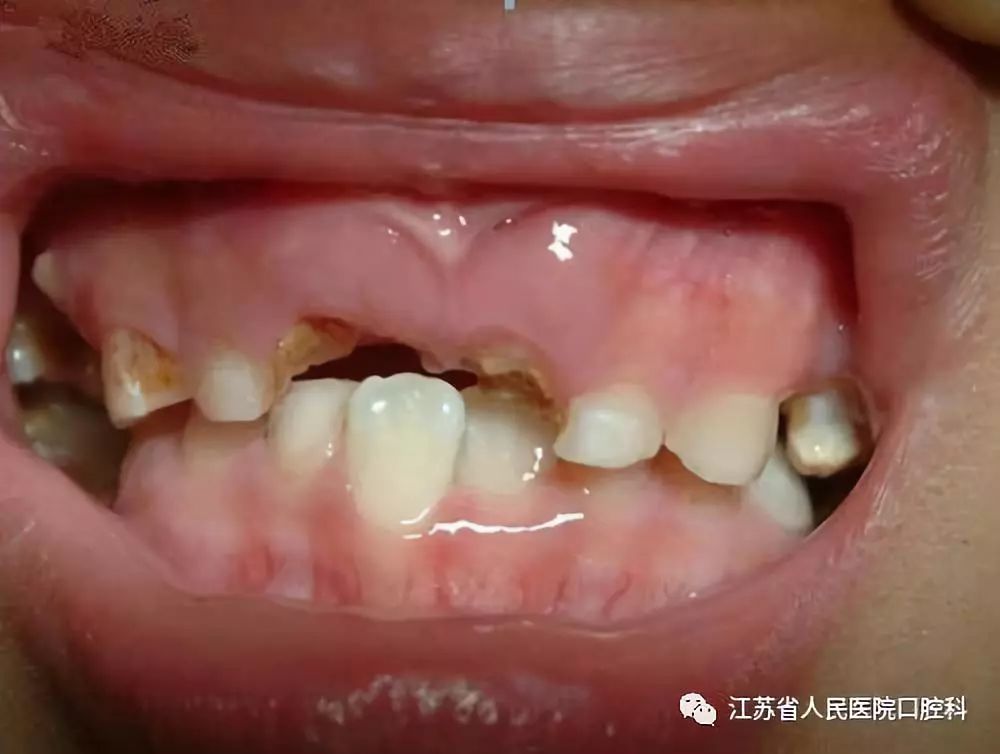 换牙期的孩子蛀牙了怎么办