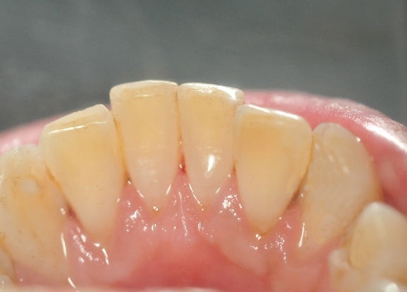 牙结石过多,导致牙根暴露,怎样才能使牙龈回到正确的位置?