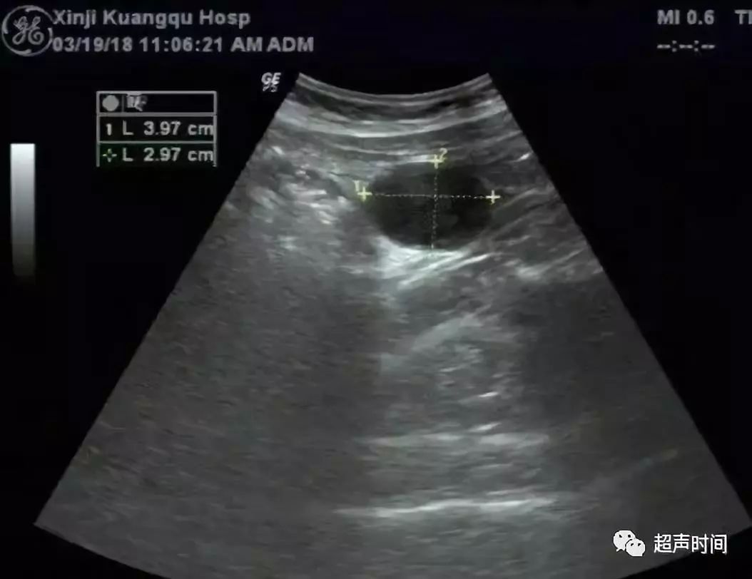 超声高手进阶累及回盲部的子宫内膜异位症