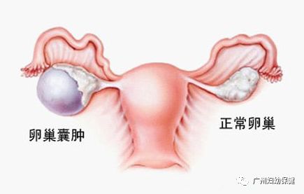 做b超说有囊肿怎么办