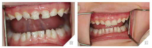 6岁孩子虫牙疼怎么办