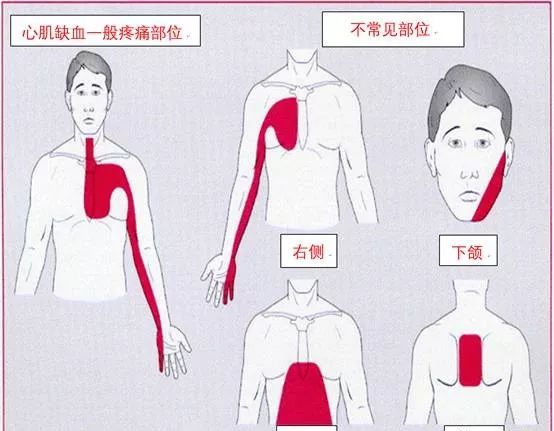 也不是字面意义上的类似于空腔脏器痉挛样的"绞痛",而是胸前区紧缩