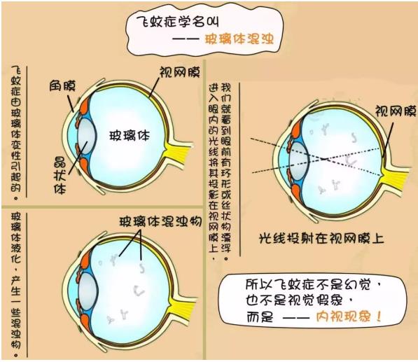 眼睛有飞蚊怎么办