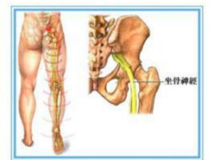 屁股痛怎么办