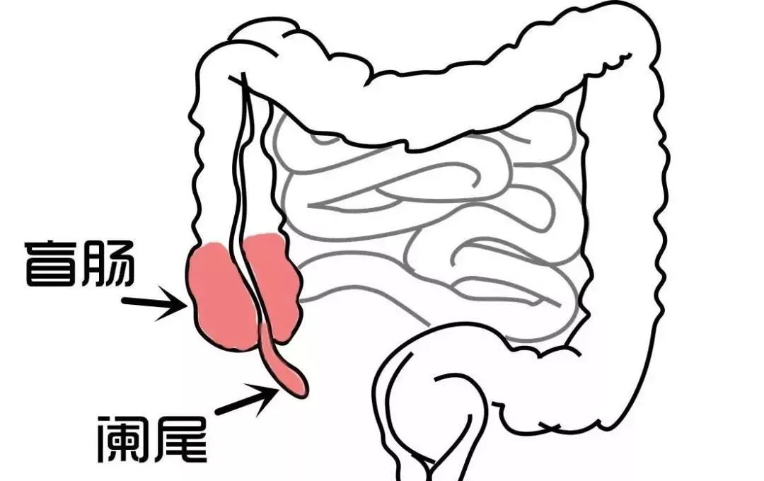 可能是急性阑尾炎