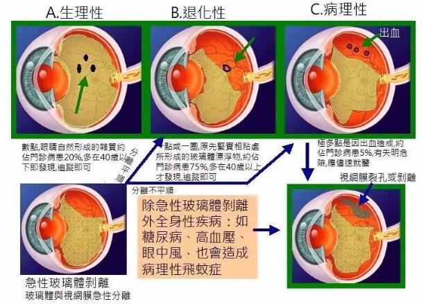 眼睛有飞蚊怎么办