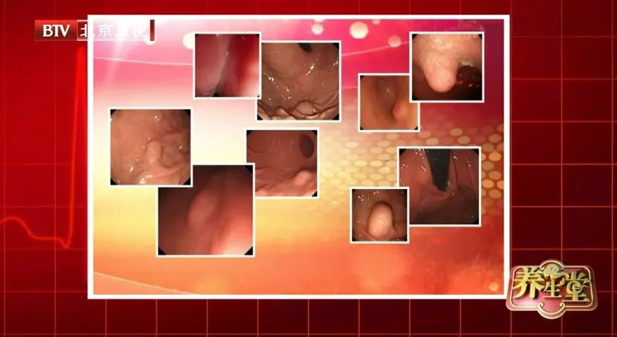 健康 正文  ▲胃癌患者胃镜下的病变图 这个"看不见"的肿瘤就是病危