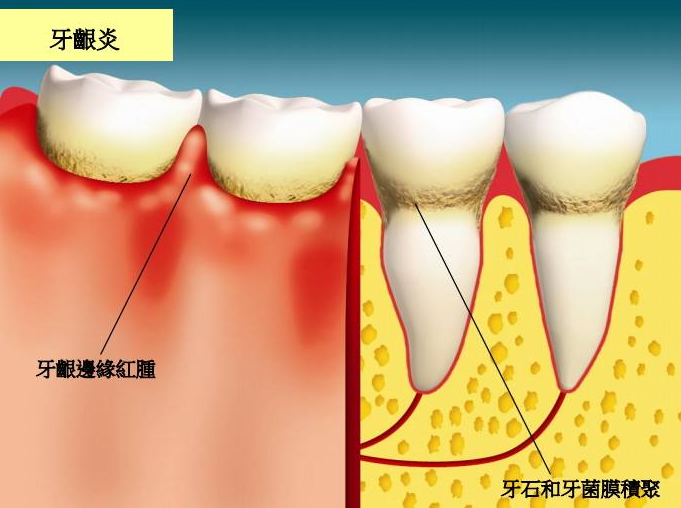 2,牙龈颜色:牙龈呈粉红色患龈缘炎游离龈龈乳变深红或暗红色由于牙龈