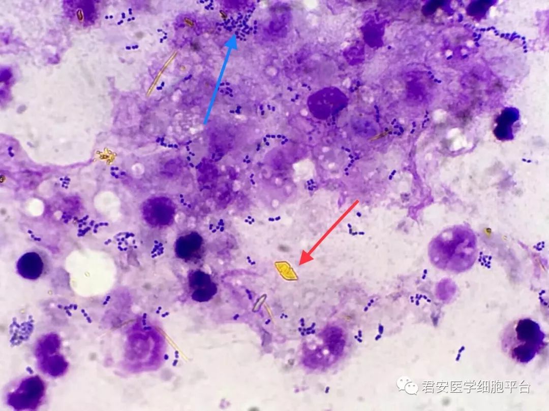 橙色血质结晶(↑), 细菌(↑) 细菌(↑) , 脂肪球(↑) 涂片镜检提示有