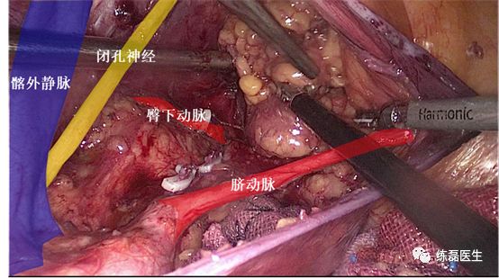 继续沿髂内动脉向远端分离,直至完全游离淋巴结组织.