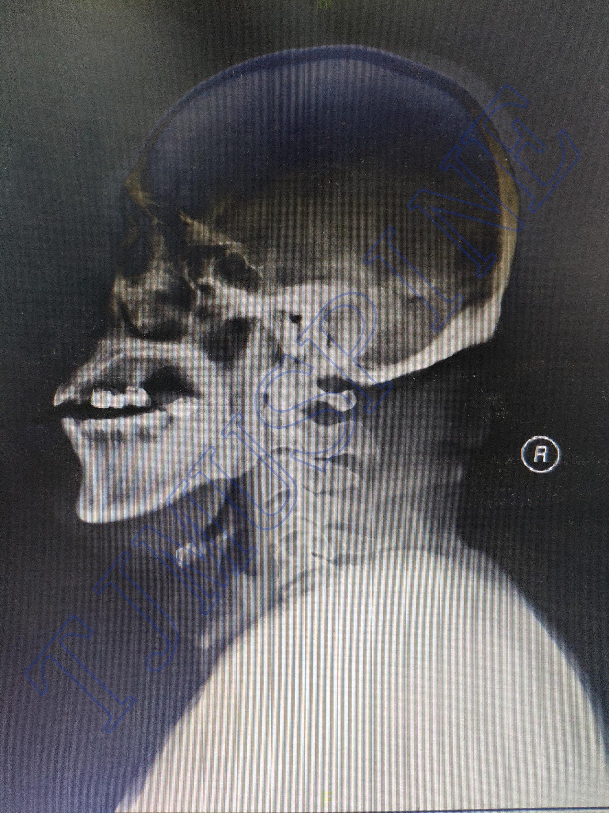 寰枢椎后路切开复位内固定术治疗陈旧性齿突骨折伴C 1,2 不稳症
