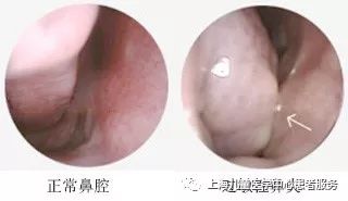 【健康大講堂】打噴嚏、流鼻涕，是感冒還是過敏性鼻炎？ 健康 第5張