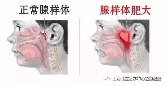 【健康大講堂】打噴嚏、流鼻涕，是感冒還是過敏性鼻炎？ 健康 第12張