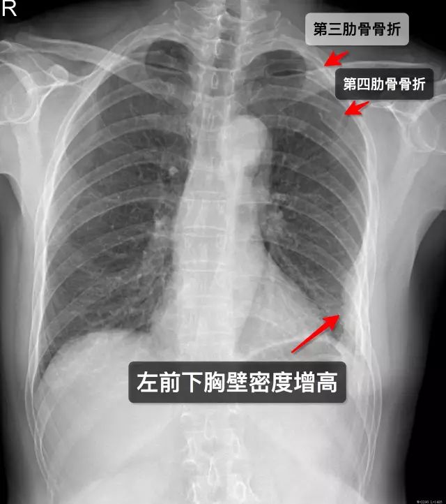 那些年你漏诊过的肋骨骨折