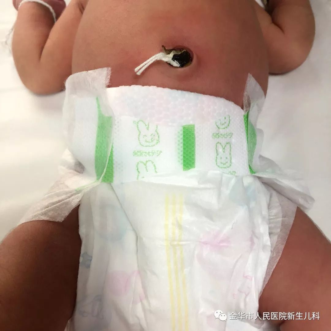 手把手教宝妈如何护理新生宝宝的脐带