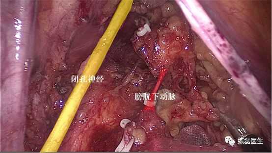 图21 处理膀胱下动脉图22.