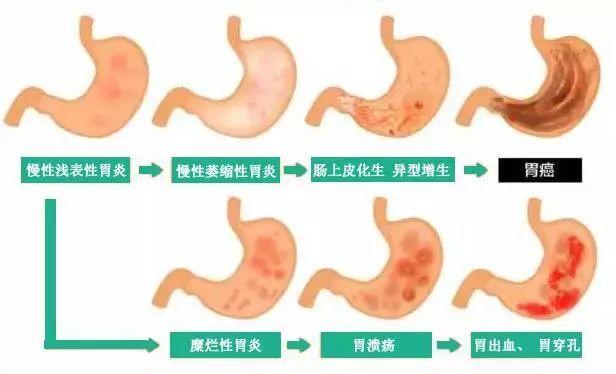 慢性萎缩性胃炎会转变成胃癌吗？_治疗