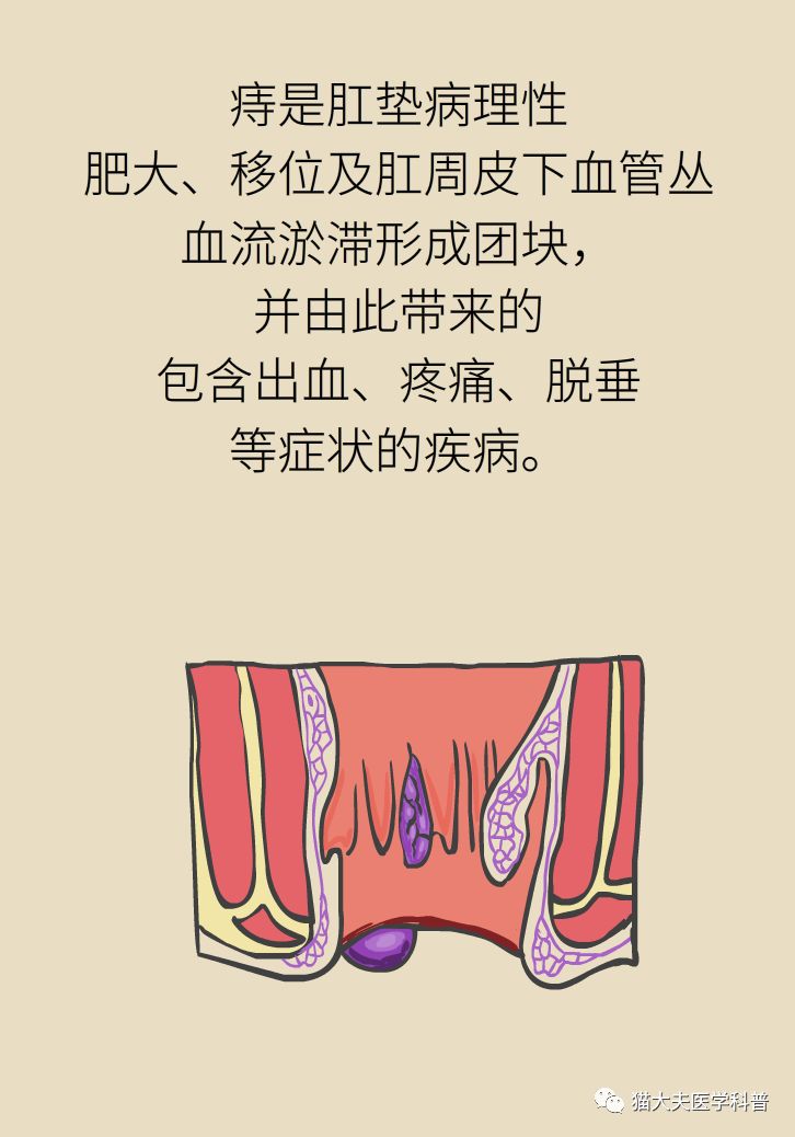 得了痔疮是一种什么样的体验?