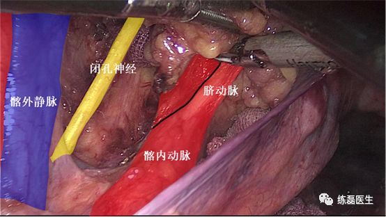 图18. 分离显露脐动脉