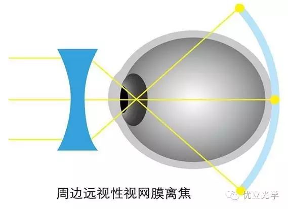 儿童近视怎么破?随他去?不阔能!