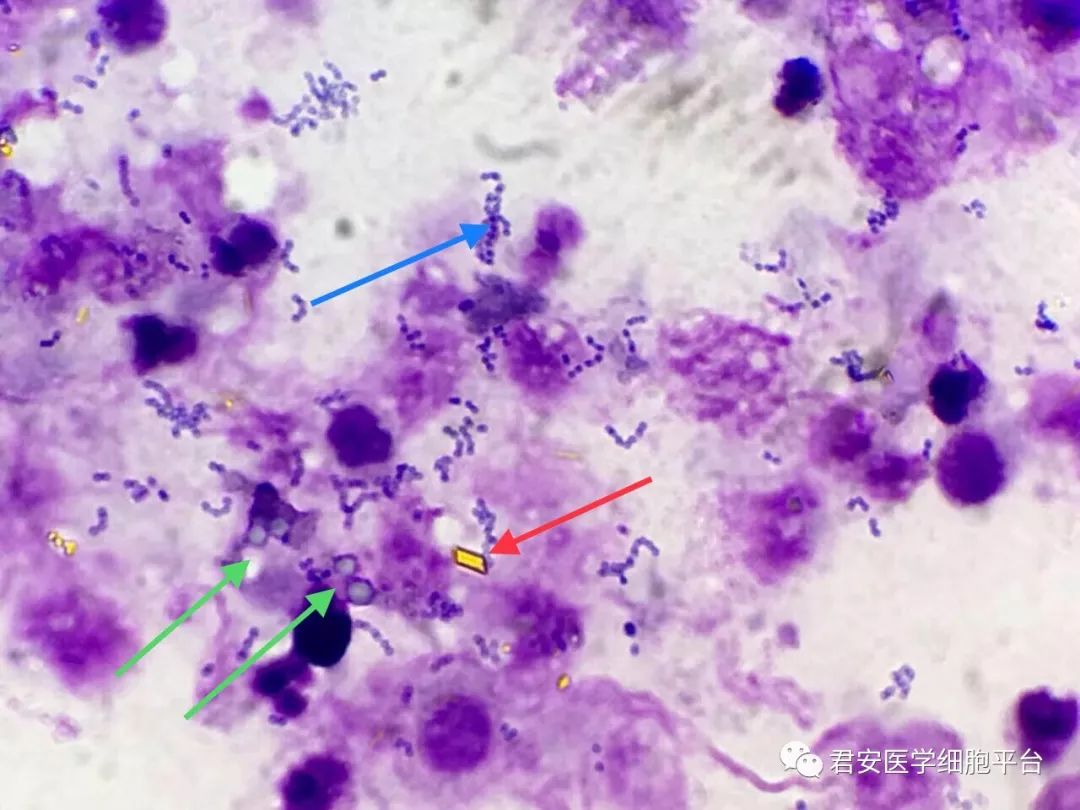 细胞脓性坏死,伴橙色血质结晶出现,并可见较多细菌和少量真菌及脂肪球