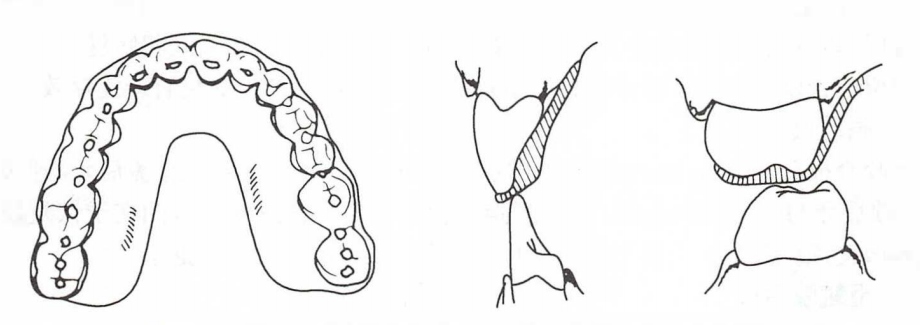 颞下颌关节紊乱-咬合板的类型及适应证