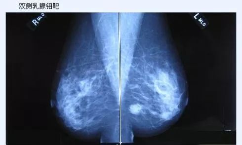 乳腺癌的早期发现和确诊