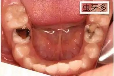 还会造成各种牙齿问题 「 1 」 这个原理同口腔溃疡和扁桃体,腺样体