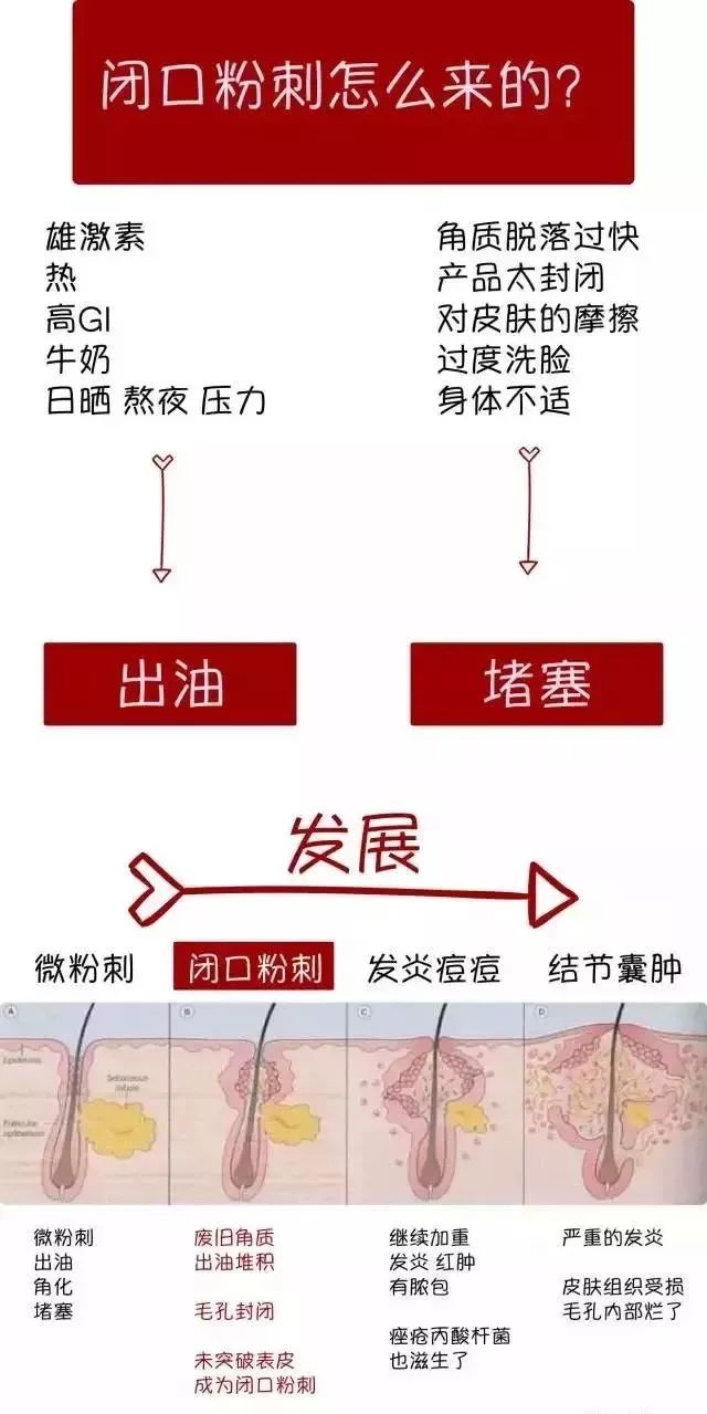 王医生什么是闭口粉刺闭口粉刺怎么祛除