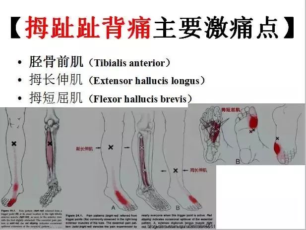 疼痛治疗必备的《全身激痛点手册》肌筋膜疼痛与功能障碍图文全解