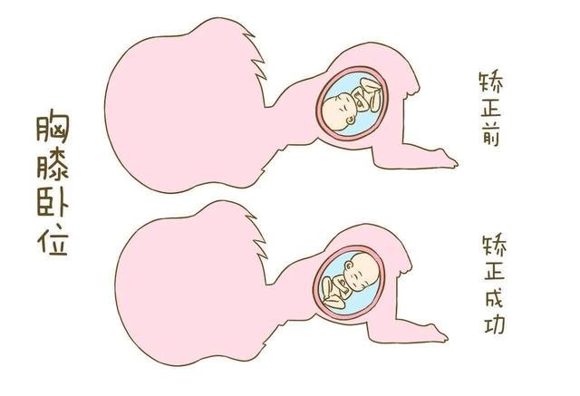 所以如果到临产时胎儿还是横位或臀位,一般情况下医生会建议剖腹产.